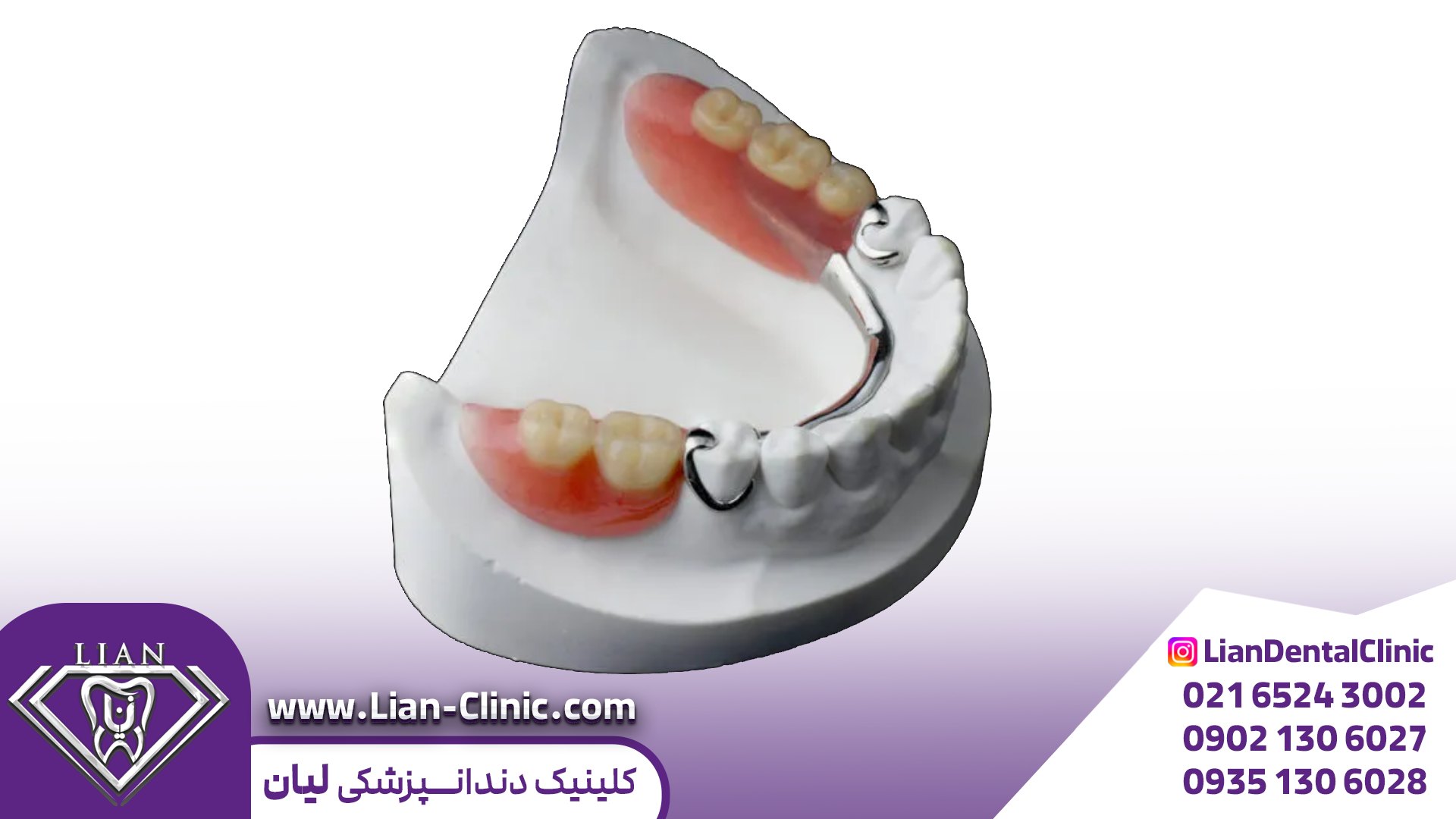 پروتز پارسيل دندان در شهریار| دندان مصنوعی ثابت و متحرک در شهریار|دندانپزشکی اقساطی در شهریار