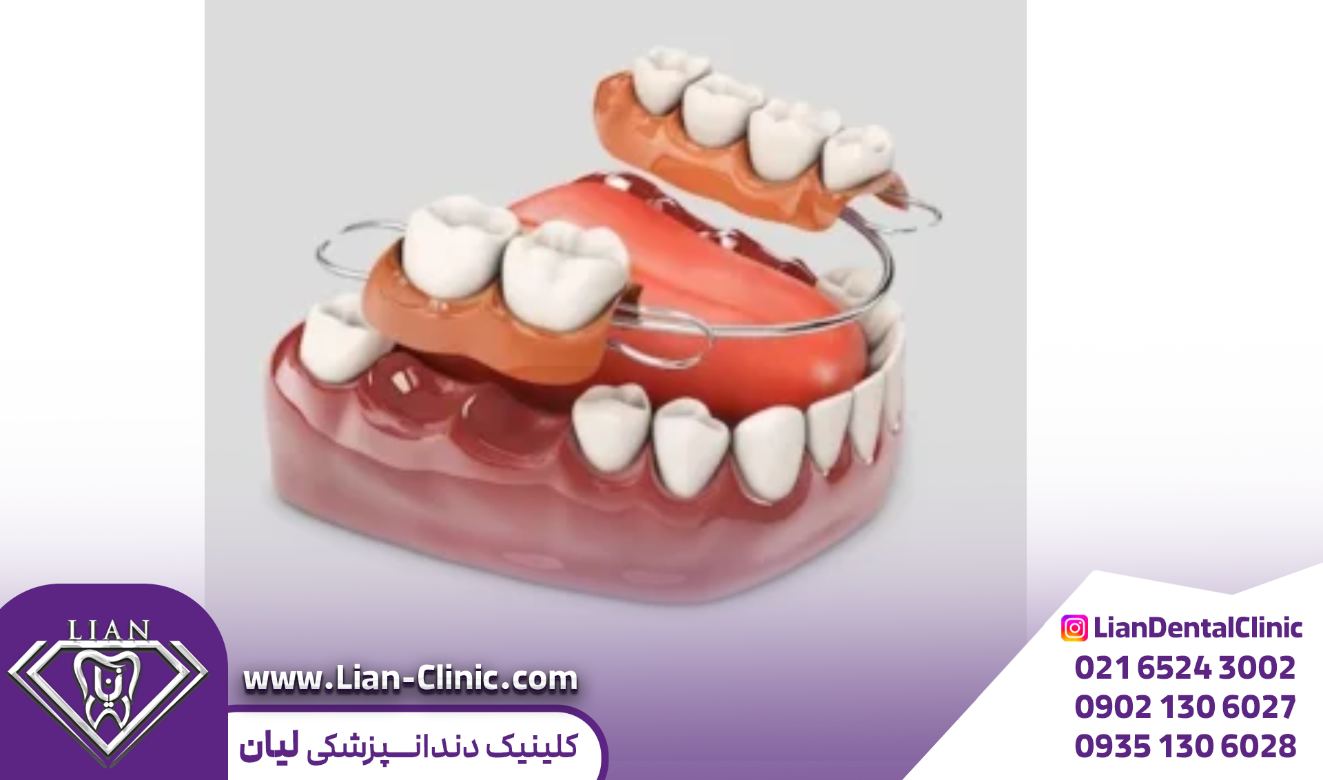بریج و امپلنت