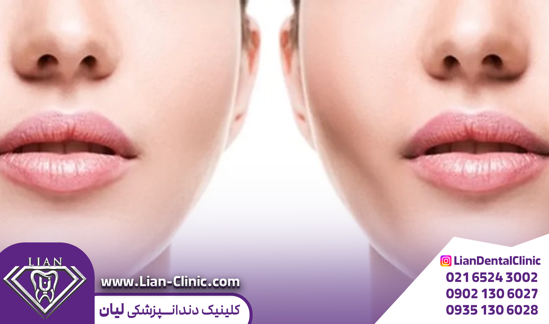 جراحی بوکال فت چیست؟