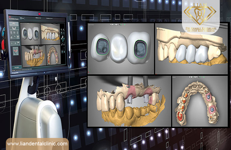 ایمپلنت دیجیتال در شهریار|بهترین متخصص ایمپلنت دندان در شهریار