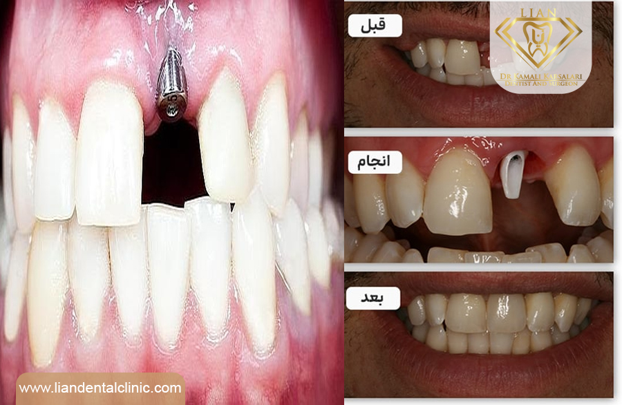 ایمپلنت فوری در شهریار|متخصص ایمپلنت فوری در شهریار|بهترین متخصص ایمپلنت دندان در شهریار
