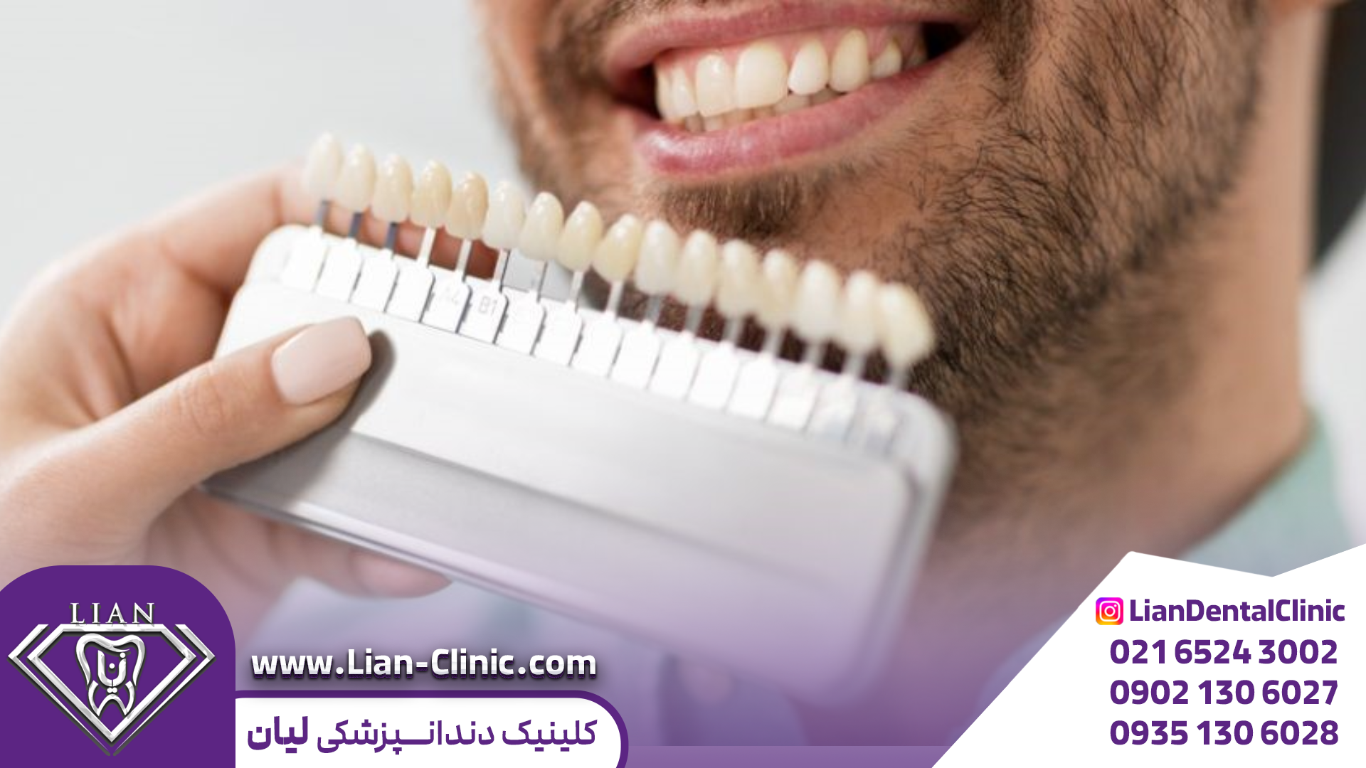 روکش ونیر