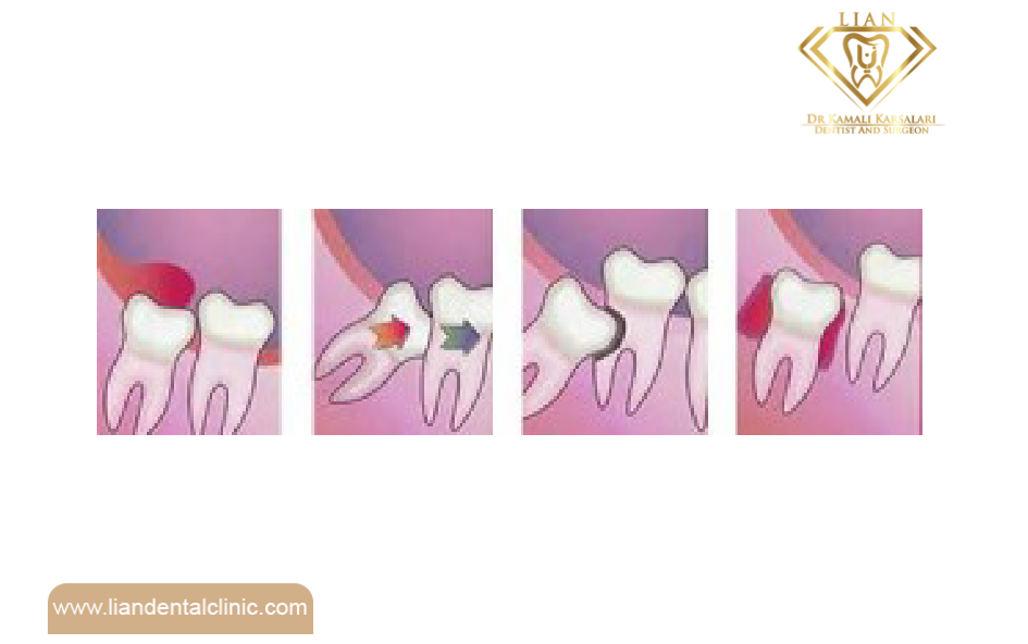 دندان عقل, مشکلات، علائم