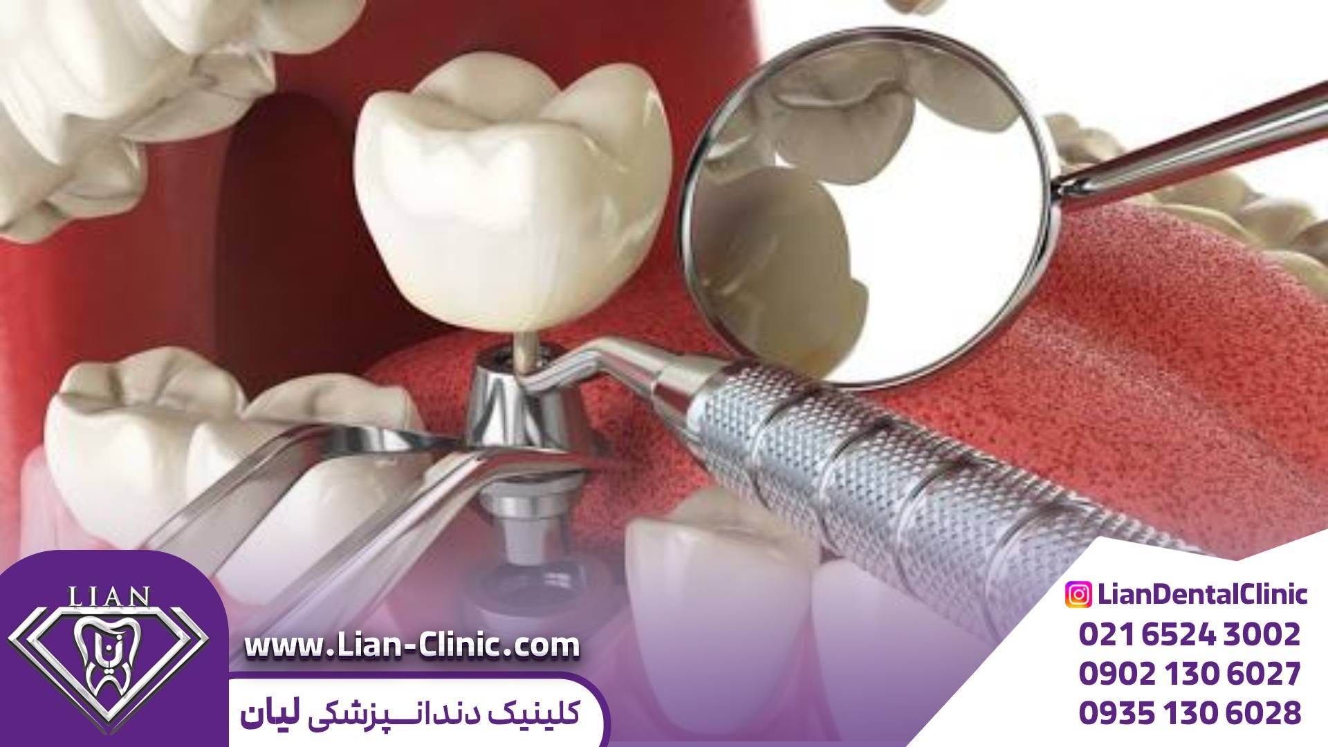 ایمپلنت دندان