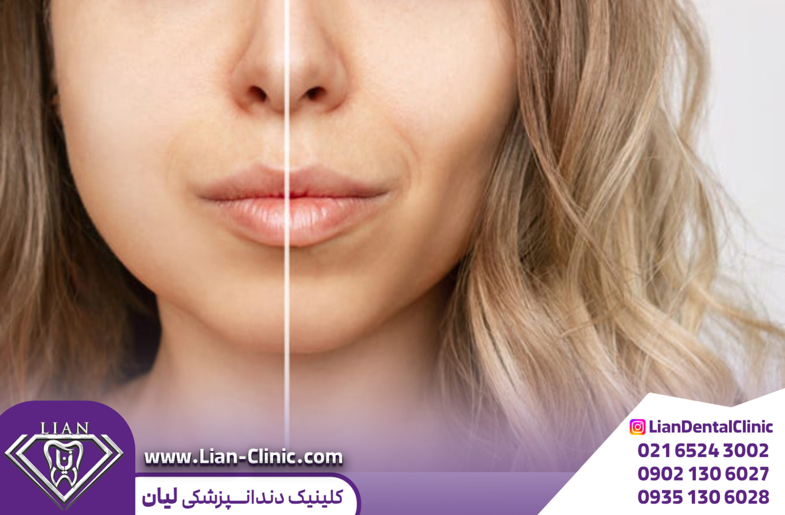 جراحی بوکال فت چیست