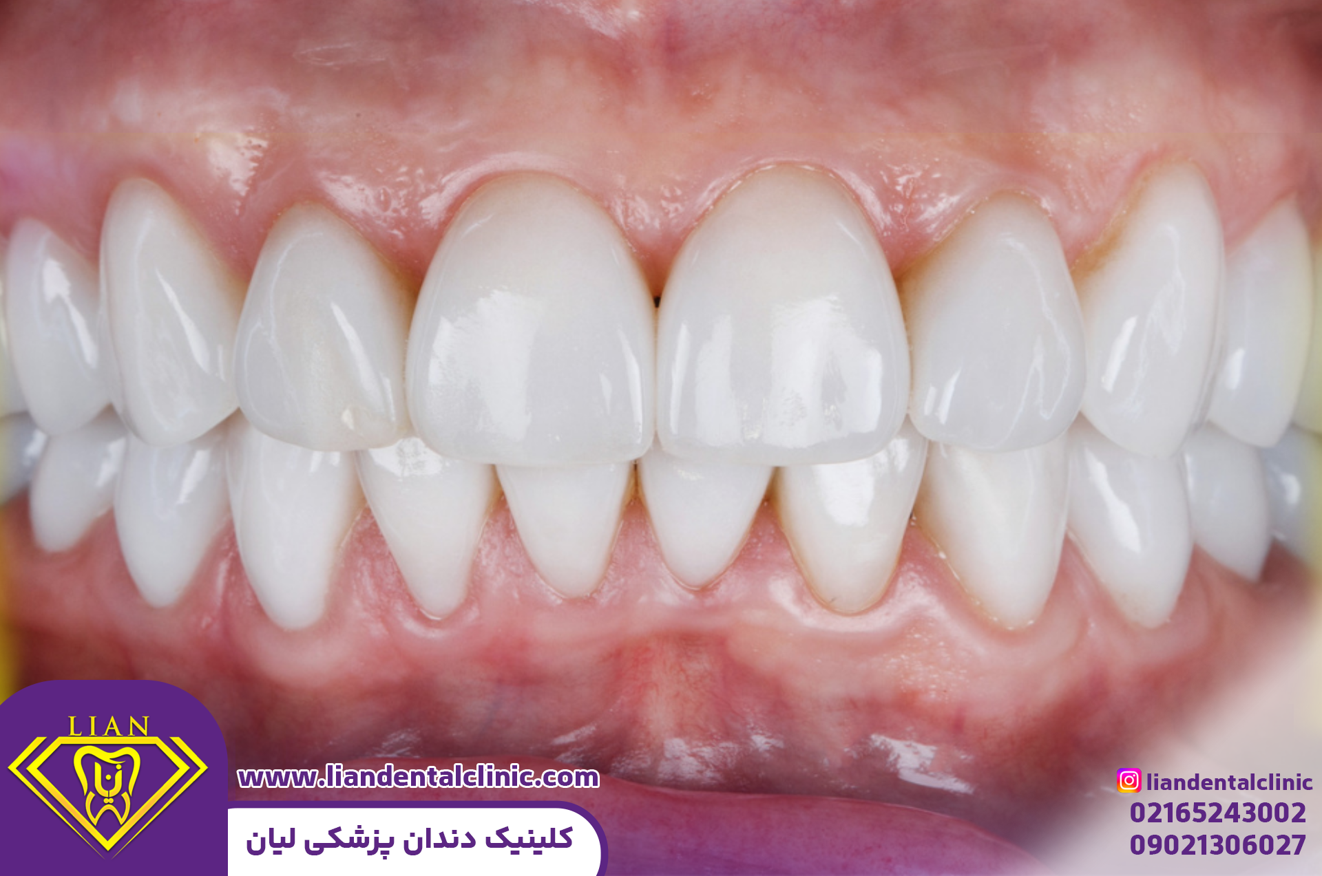 جرم گیری دندان