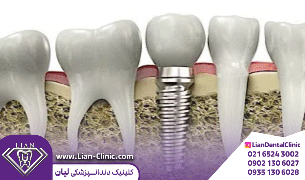 مراحل ایپلنت دندان