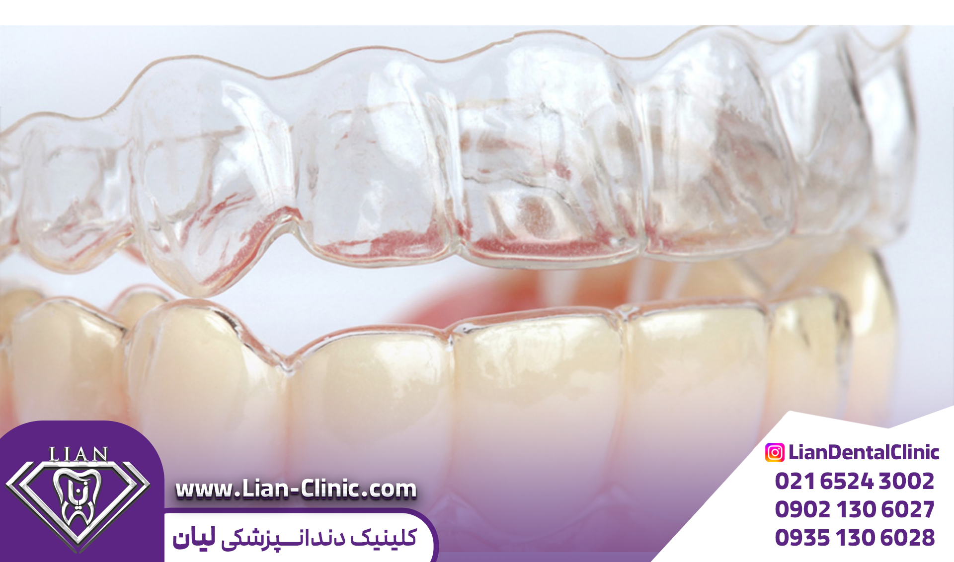 ارتودنسی نامرئی