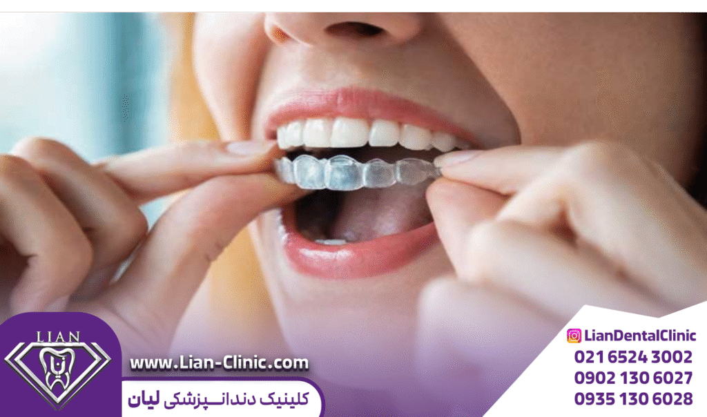 ارتودنسی نامرئی شهریار