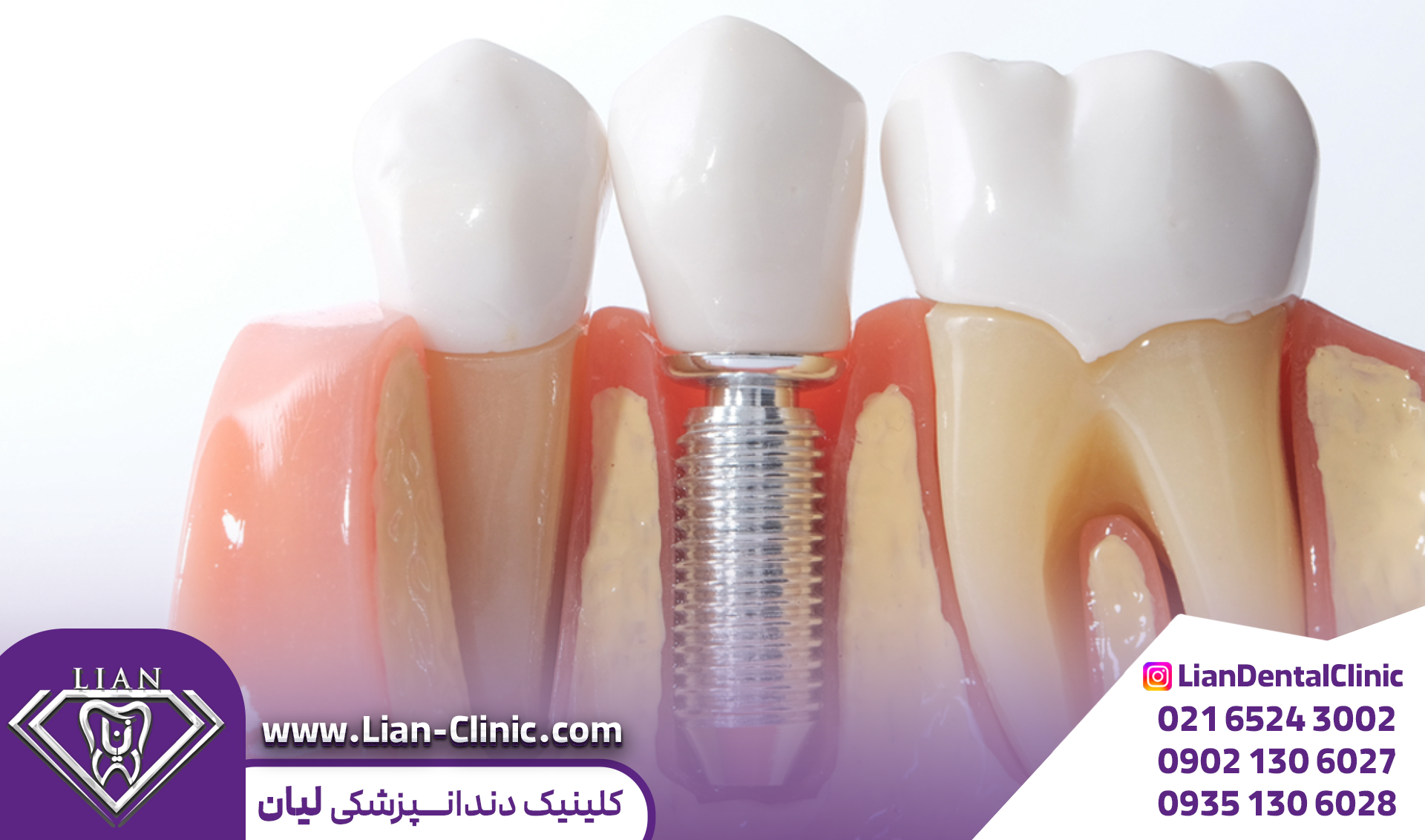 قیمت-ایمپلنت-دندان-در-شهریار