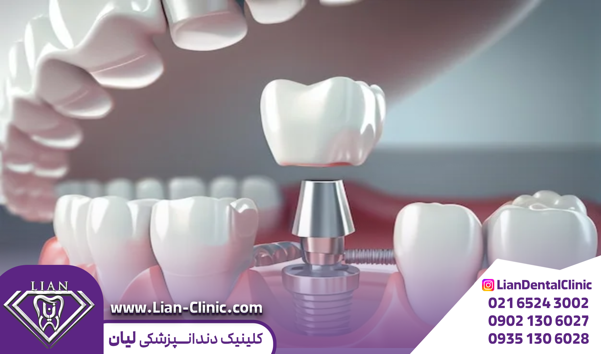 ایمپلنت بدون درد در شهریار