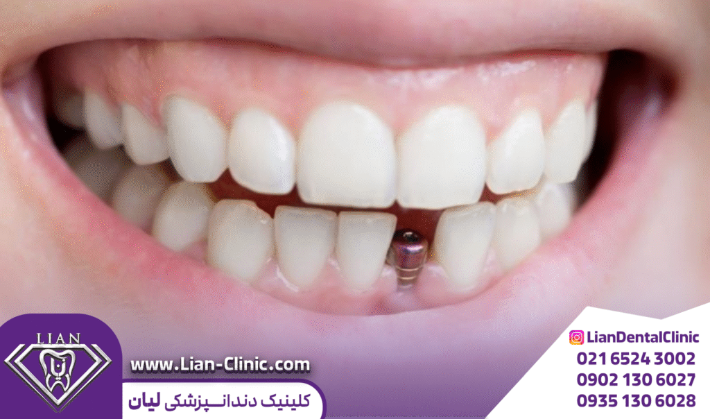 ایمپلنت فوری در شهریار