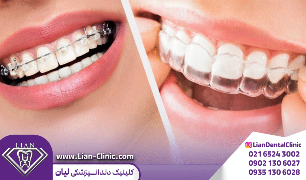 ارتودنسی شفاف و ارتودنسی ثابت