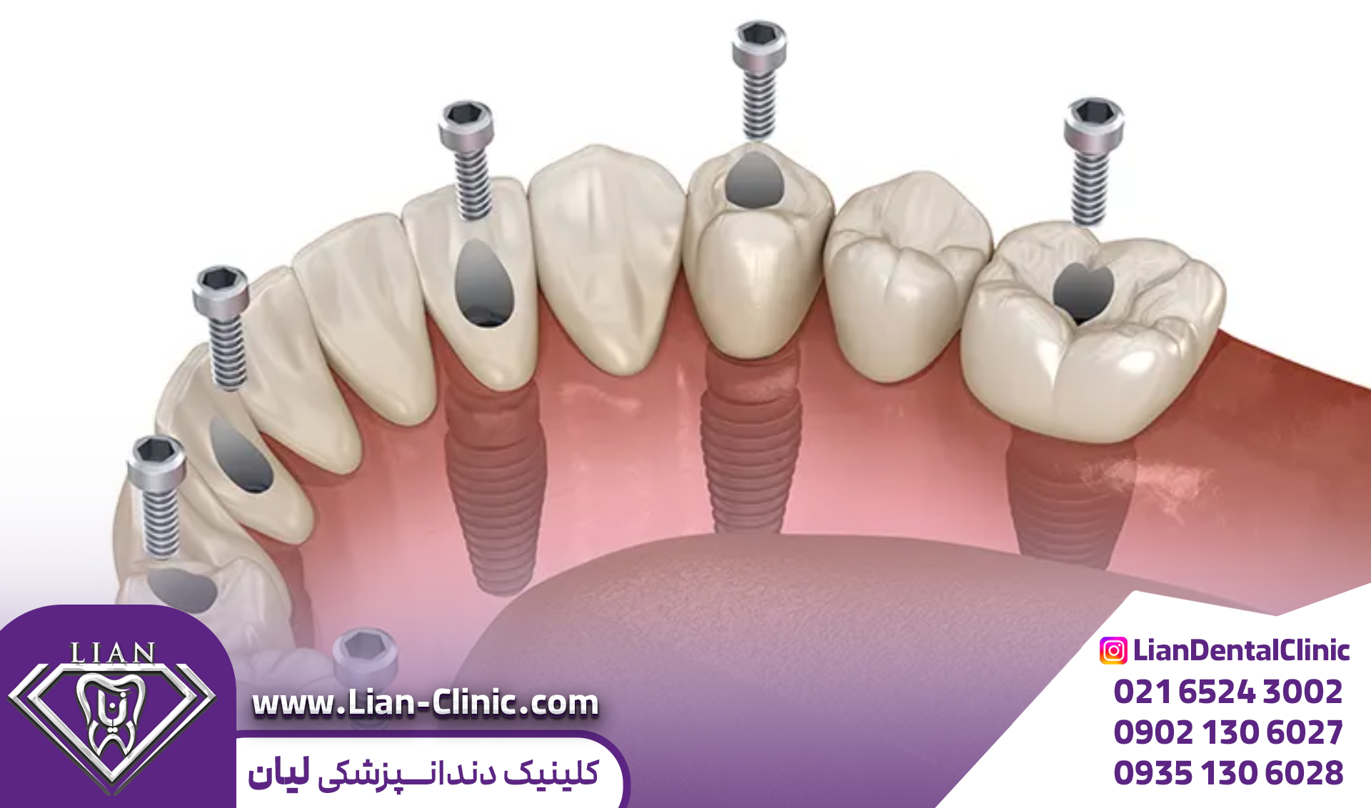 نحوه قرار گرفتن ایمپلنت دیجیتال دندان
