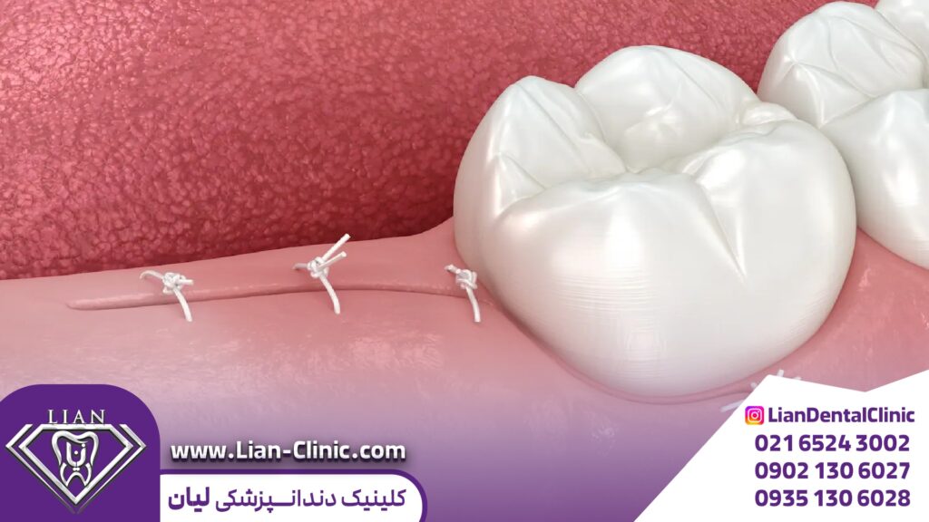 مراقبت‌های پس از جراحی دندان عقل 