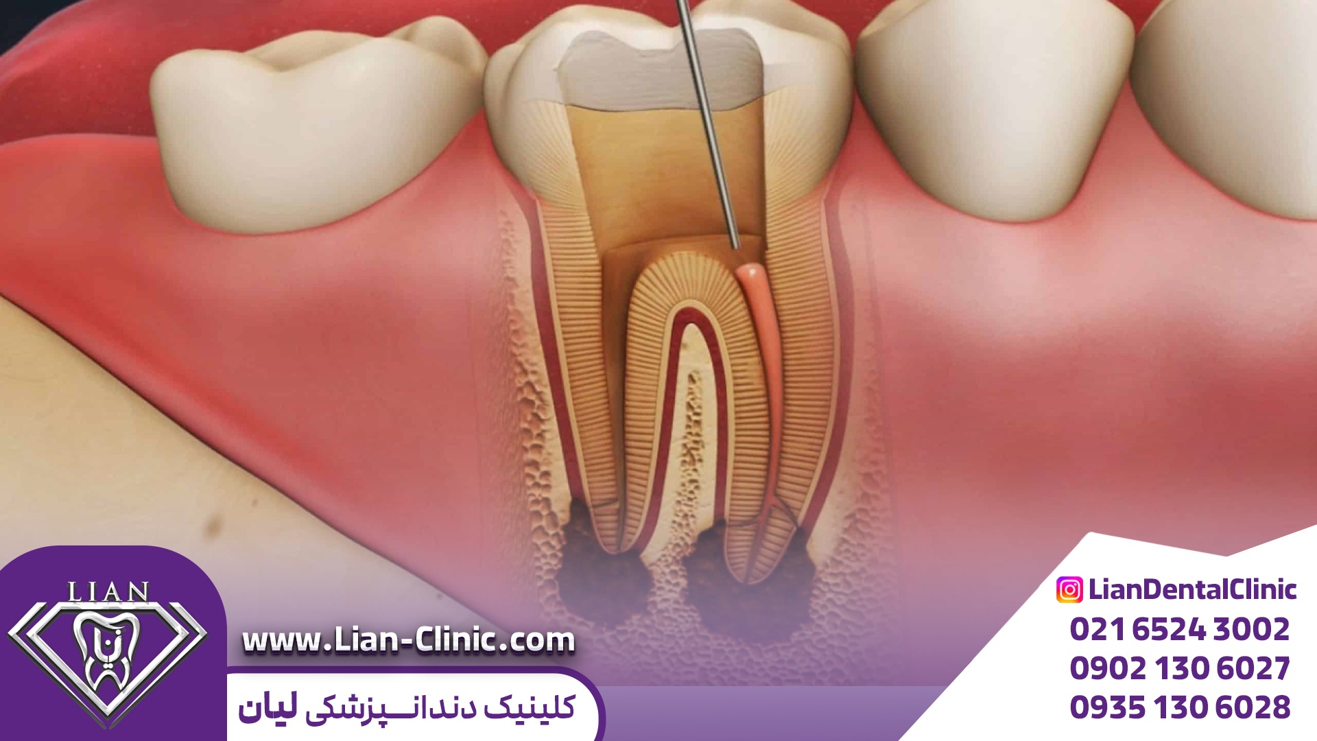 عصب کشی دندان