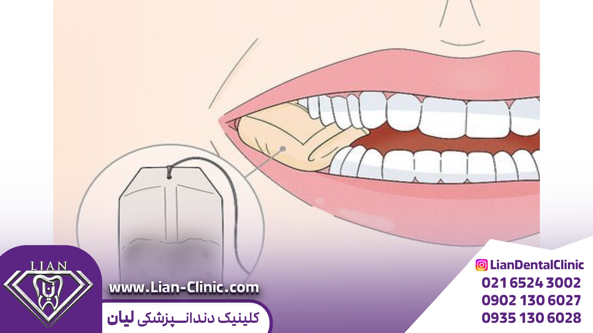 مراقبتهای پس از جراحی دندان