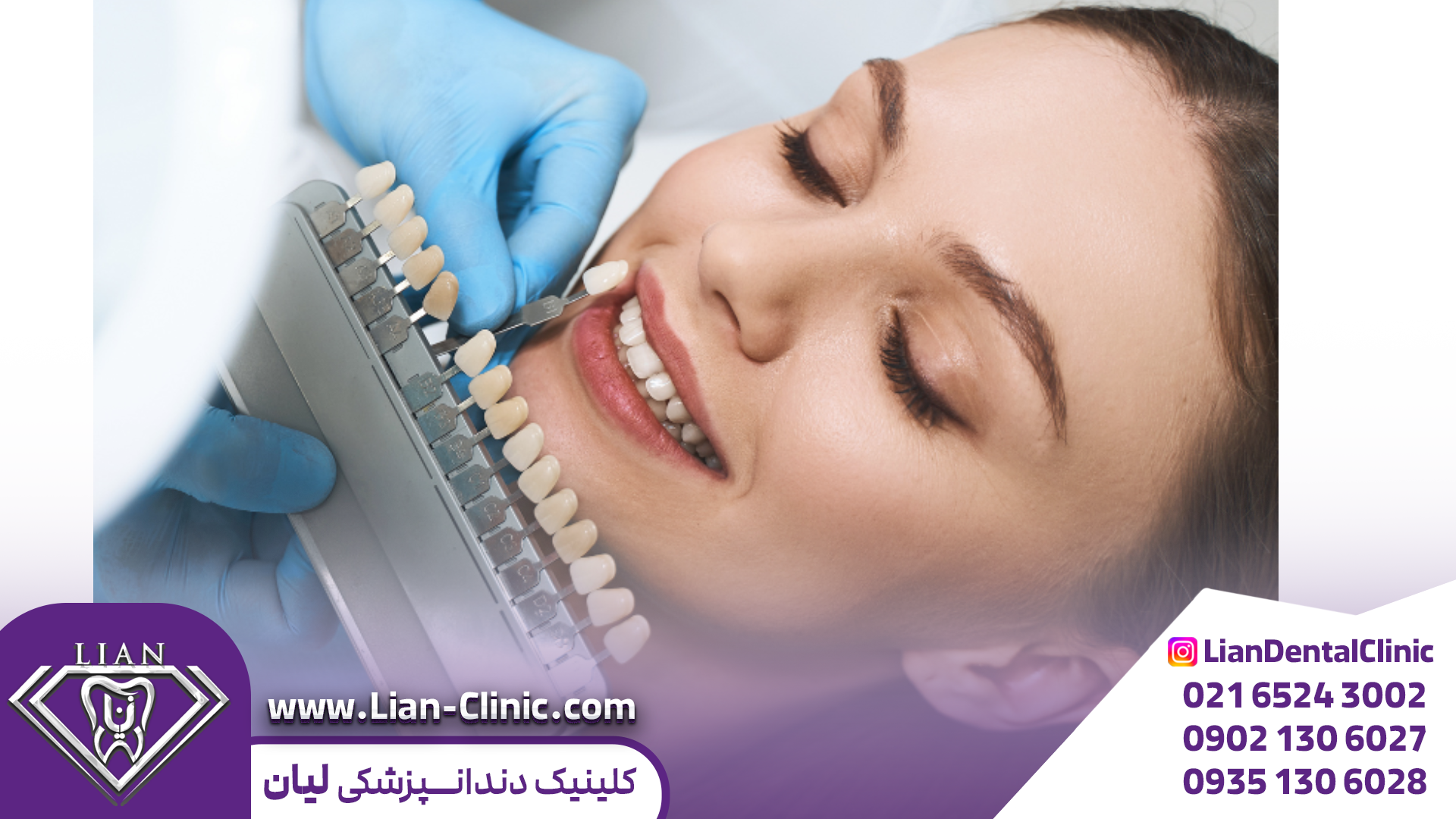 کامپوزیت دندان