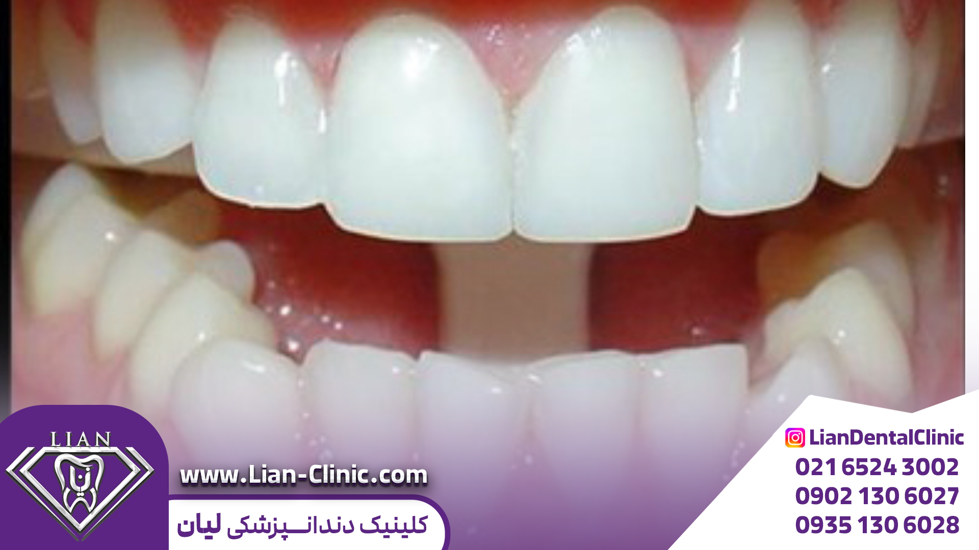 ایمپلنت زیبایی  در شهریار