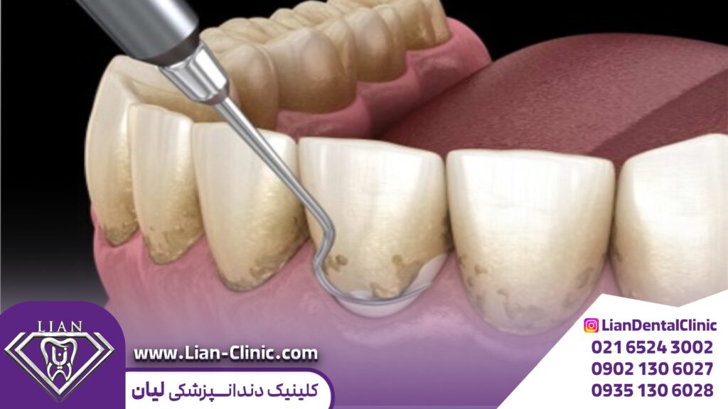 جرم گیری و پولیش دندان