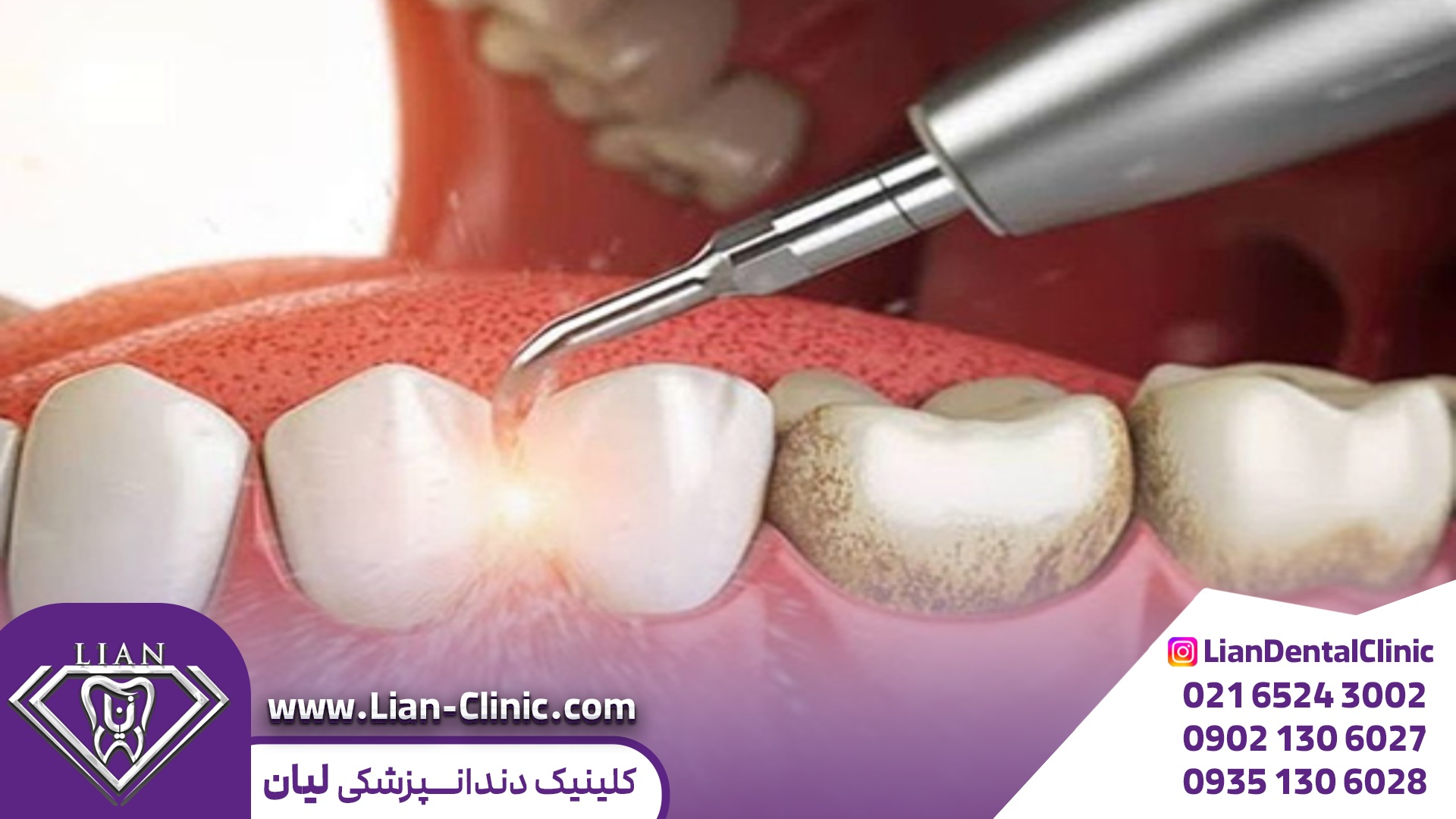 جرم گیری و پولیش دندان