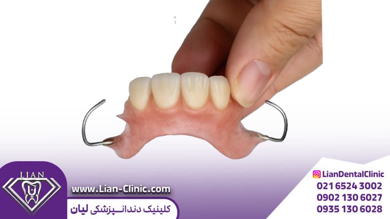 پروتز تک دندانی متحرک