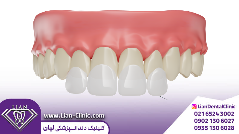 کامپوزیت دندان