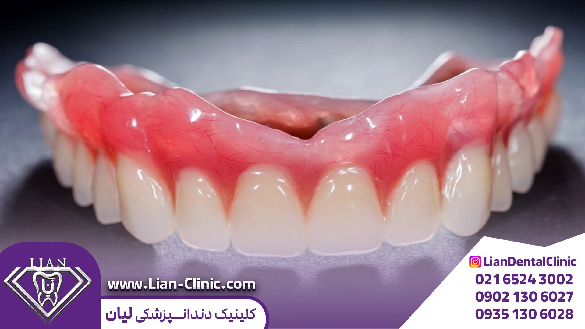 پروتز متحرک