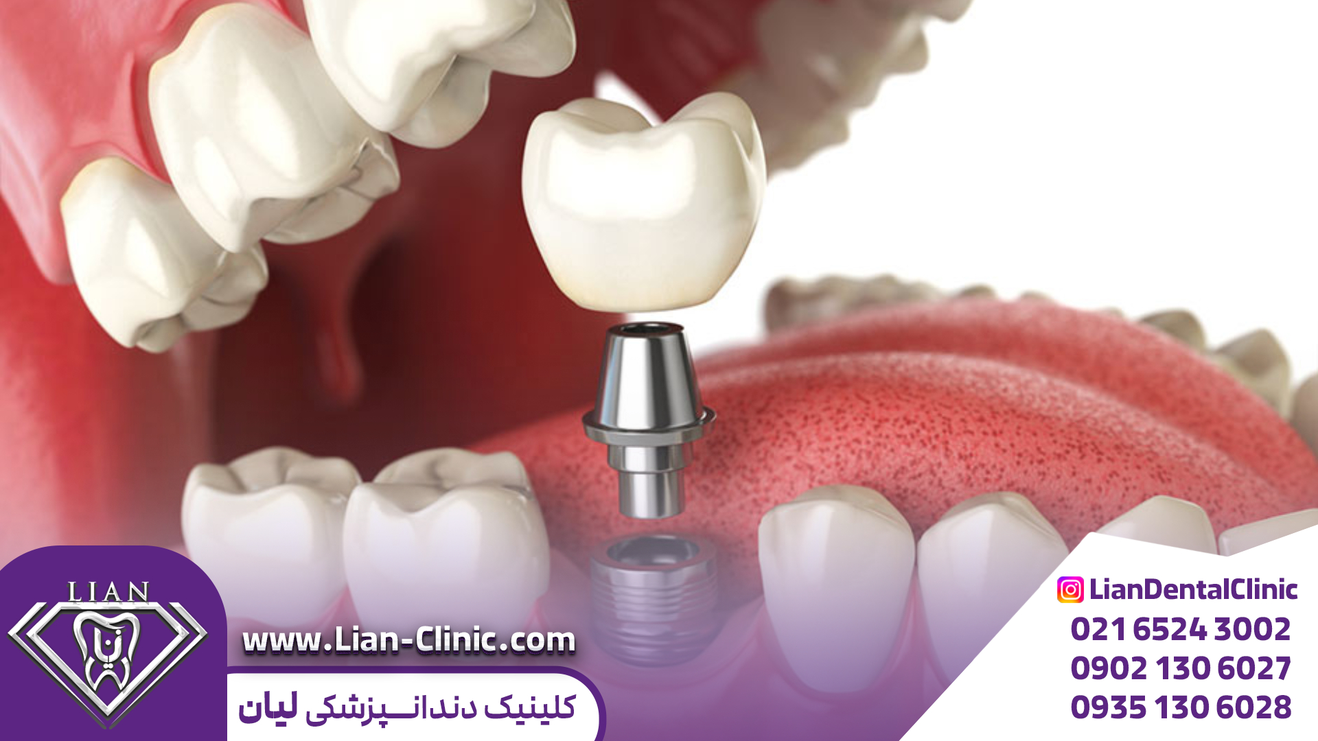 قیمت ایمپلنت دندان شهریار