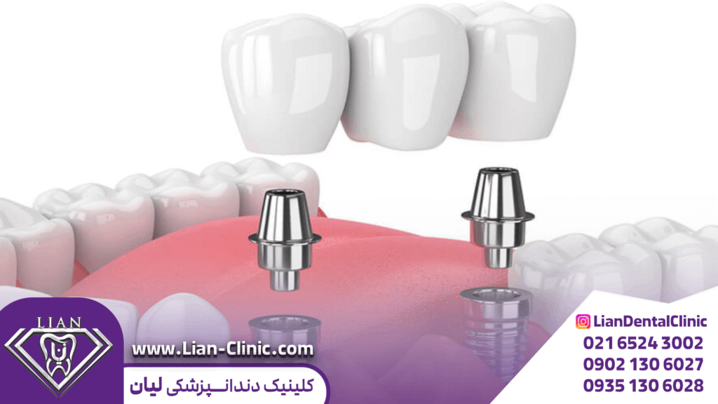 قیمت ایمپلنت دندان شهریار 