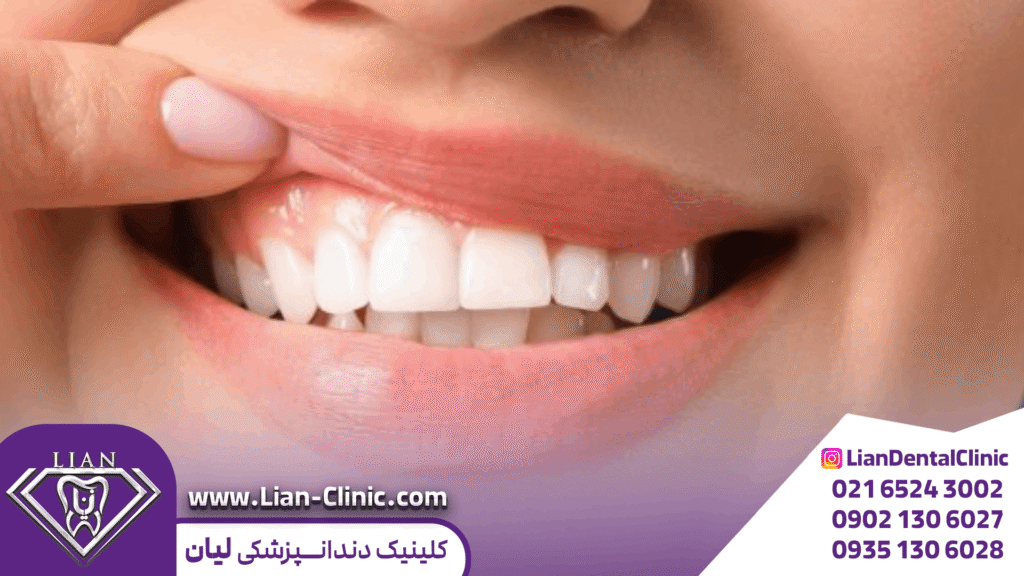 بعد از ایمپلنت