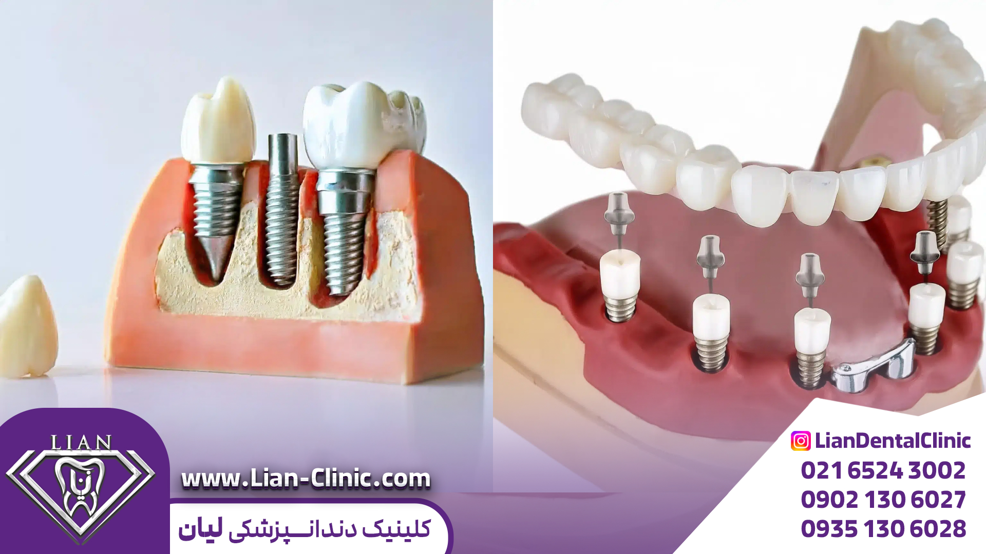 هزینه و قیمت ایمپلنت