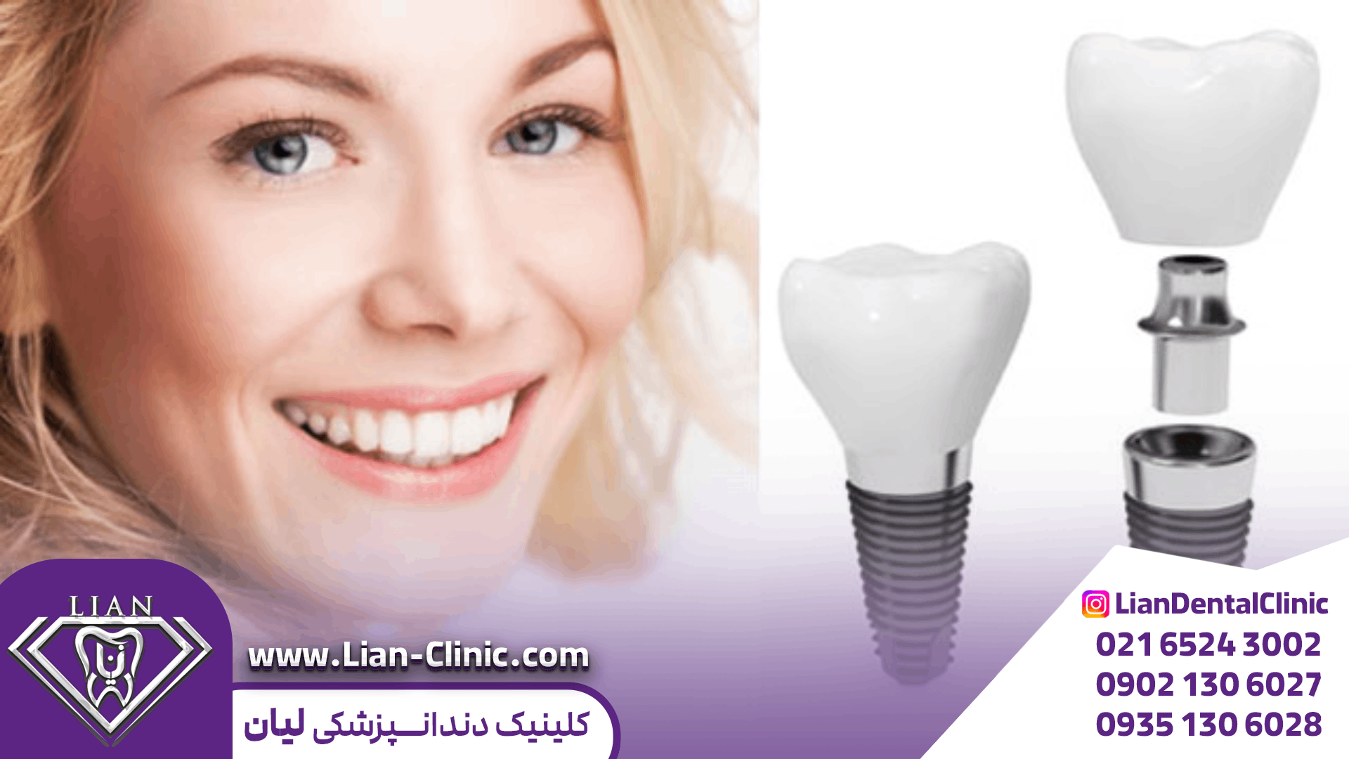 مراقبت های بعد از ایمپلنت دندان