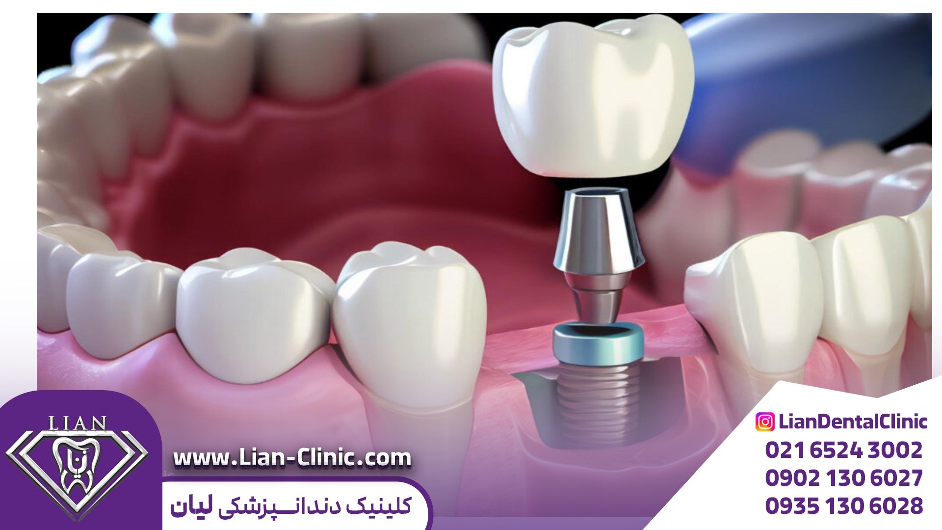 ایمپلنت فوری و معمولی