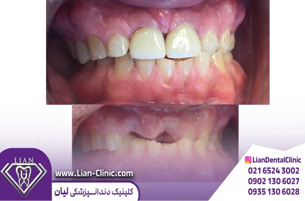 ایمپلنت فوری یا سنتی