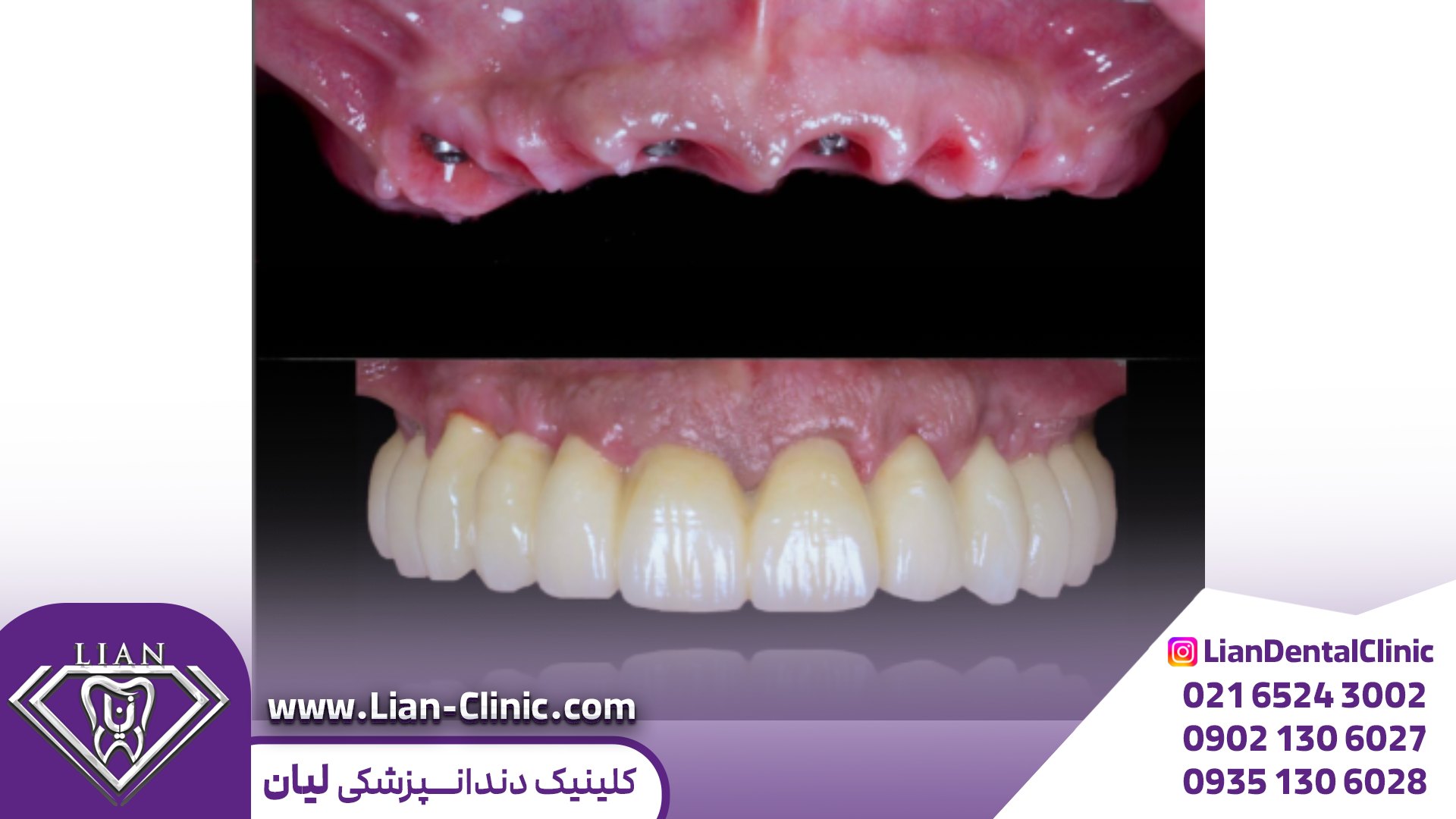 ایمپلنت دندان اقساطی